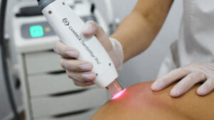 لیزر کندلا برای پوست‌های تیره